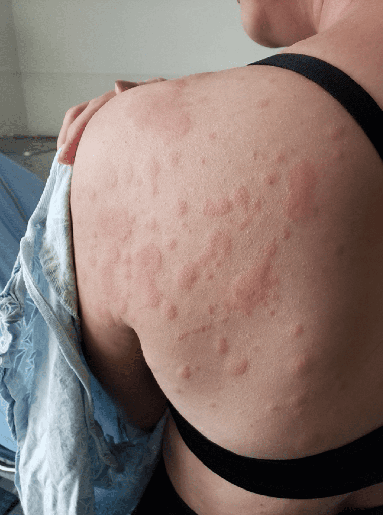 skin-rash-on-back