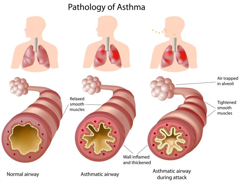 Asthma - Allergy and Asthma Consultants, LLP DBA Charleston Allergy and ...